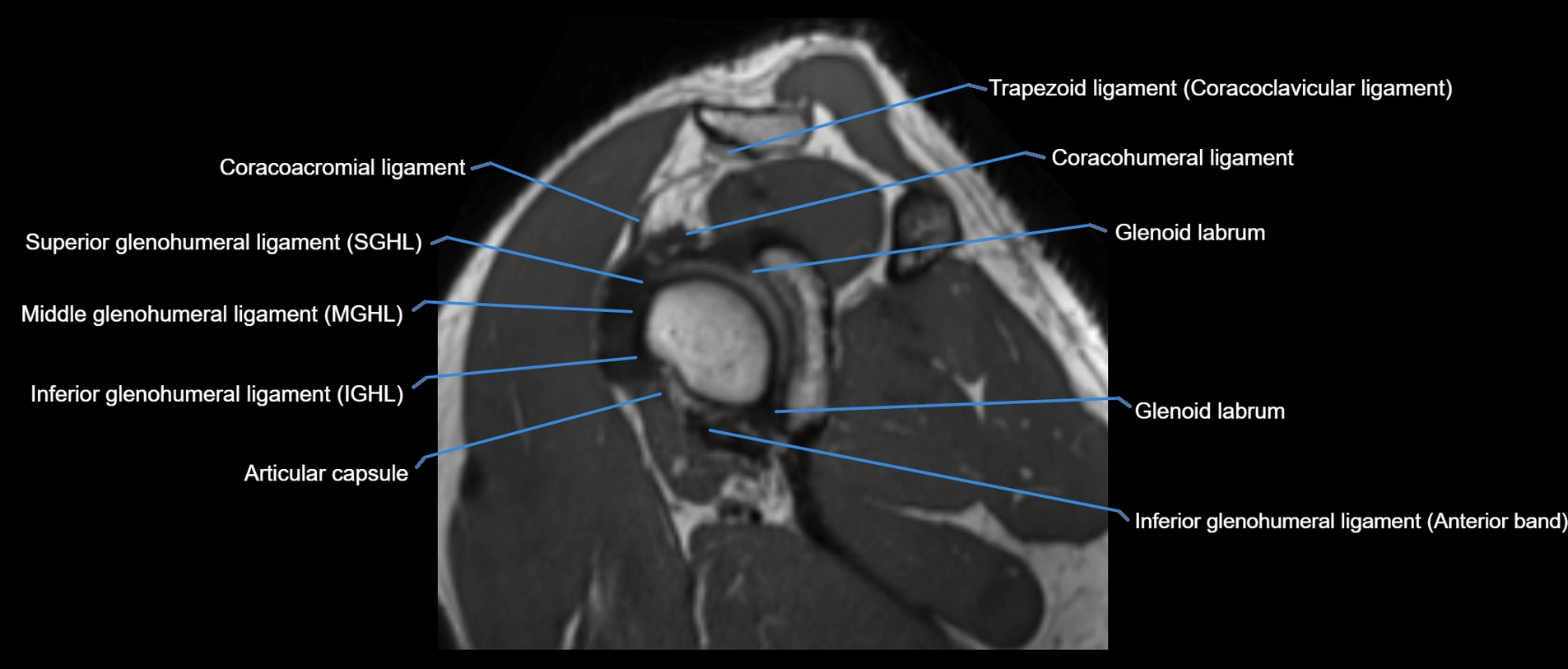 shoulder ligaments sagittal  cross sectional anatomy 3T MRI AI enhanced radiology image -img-00001-00028.webp